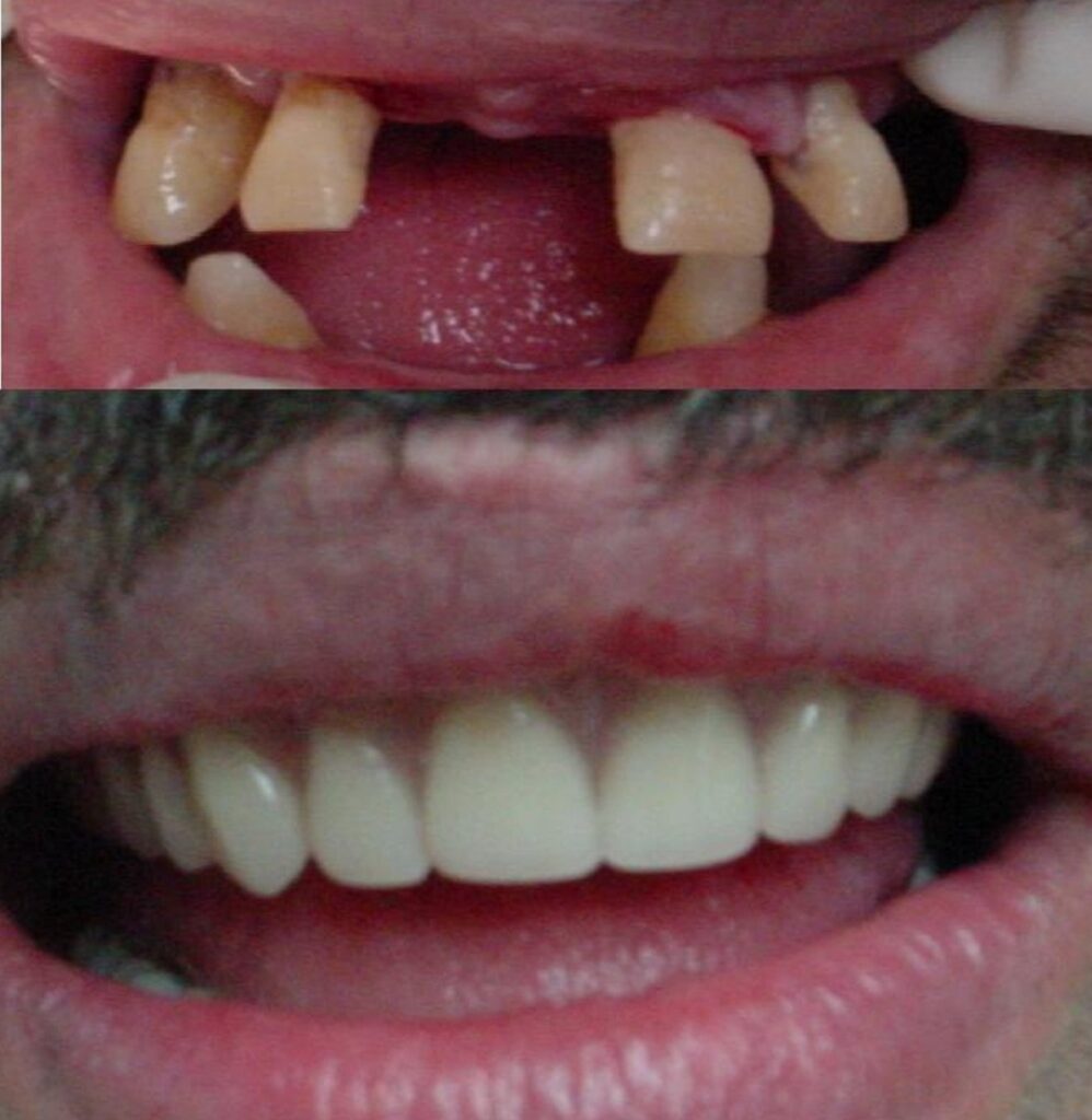 Patient before and after dentures treatment at Dental Care 4 U