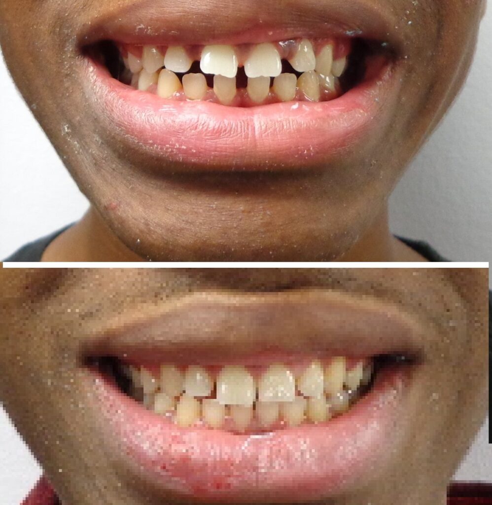Patient before and after Invisalign at Dental Care 4 U