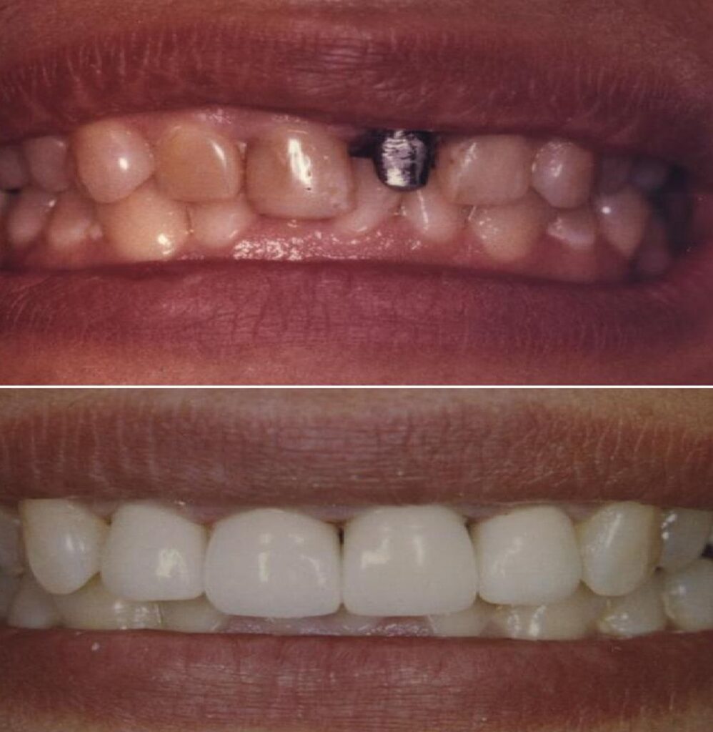 Patient before and after Crowns treatment at Dental Care 4 U