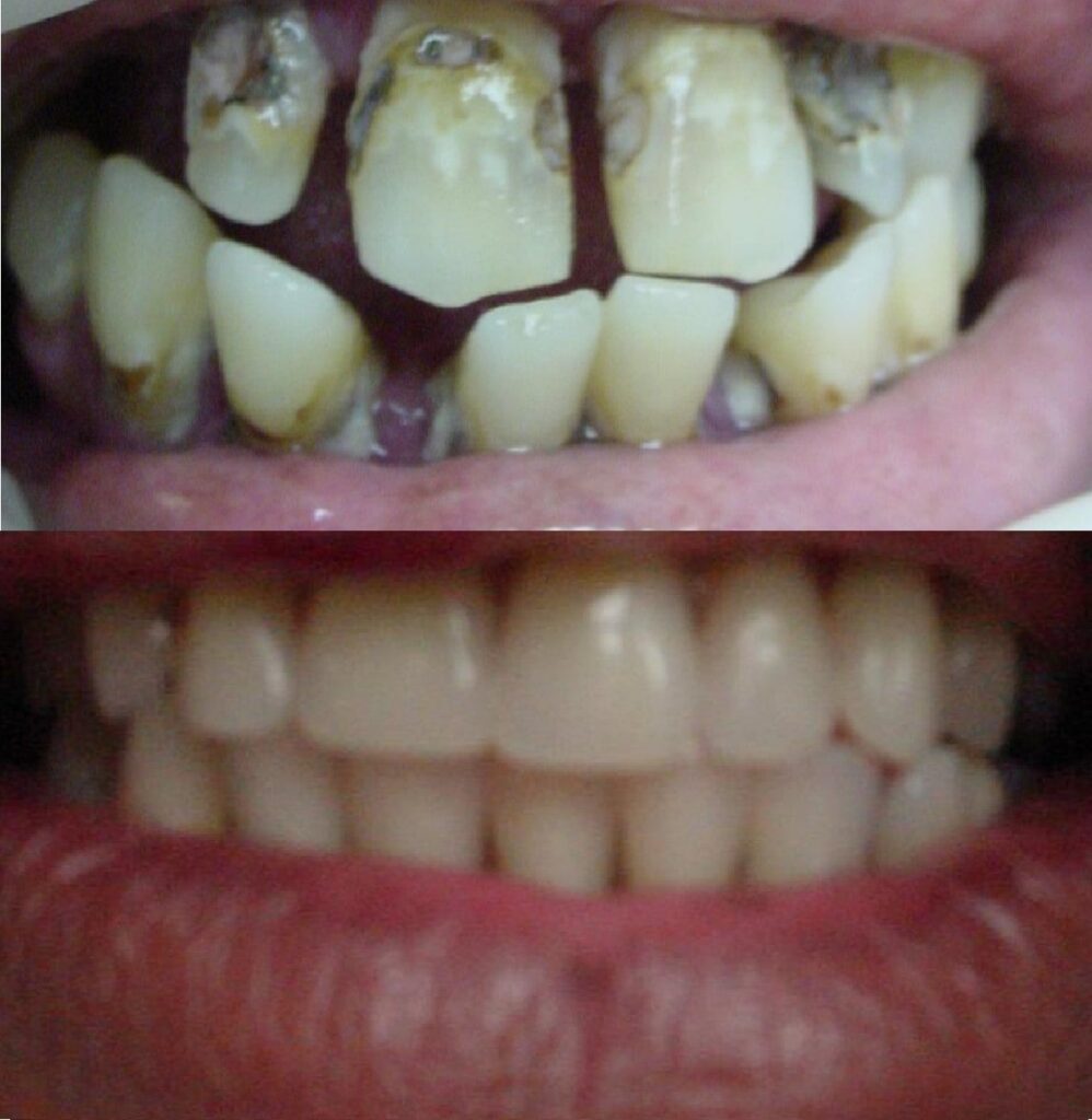 Patient before and after Denture treatment at Dental Care 4 U