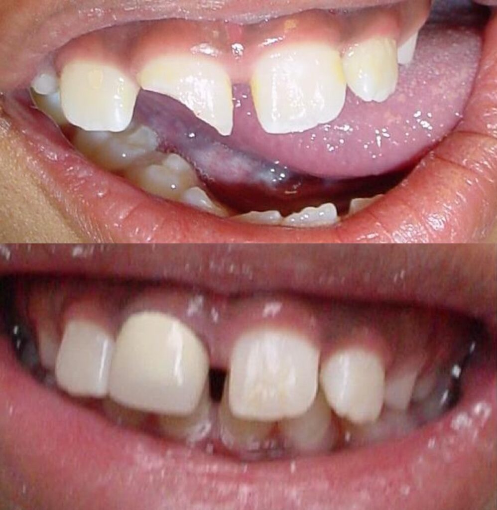 Patient before and after Filling treatment at Dental Care 4 U