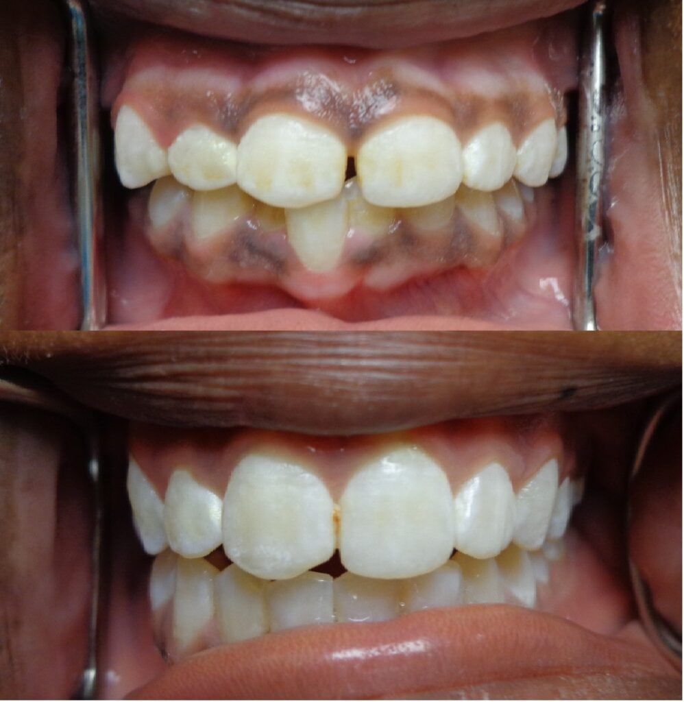 Patient before and after Invisalign treatment at Dental Care 4 U