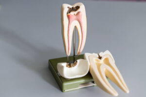 Root Canal Treatment 623291072