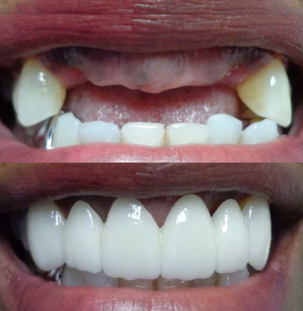 Patient before and after Permanent Fixed Bridge treatment at Dental Care 4 U