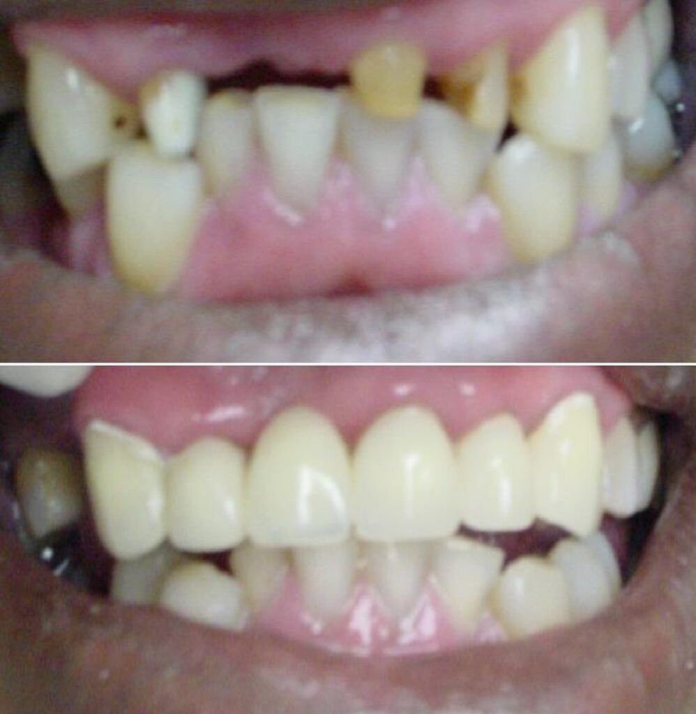 Patient before and after Permanent Fixed Bridge treatment at Dental Care 4 U