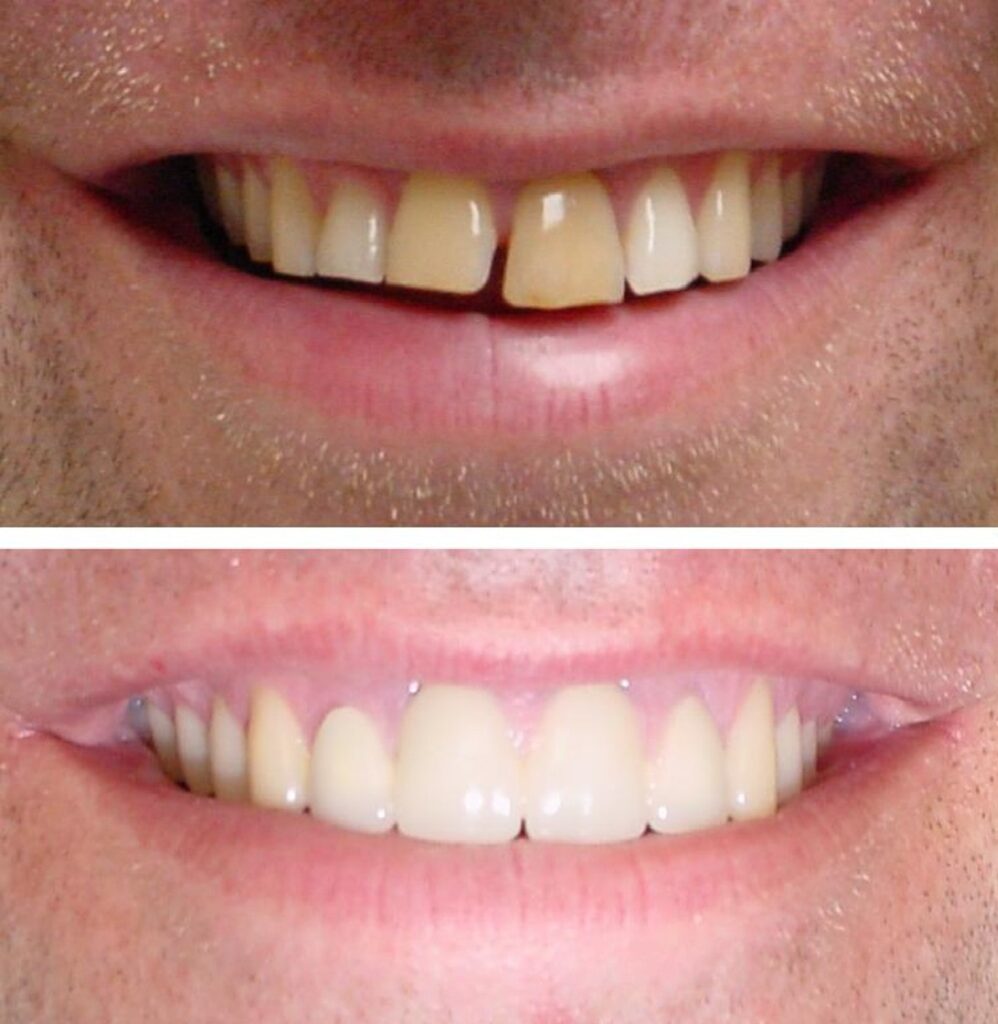 Patient before and after Crowns treatment at Dental Care 4 U