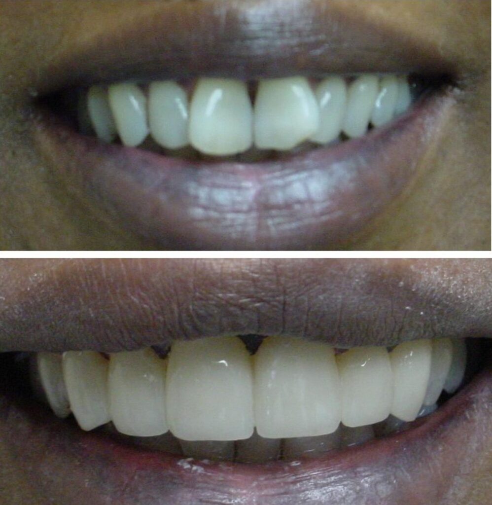 Patient before and after Cosmetic Smile treatment at Dental Care 4 U
