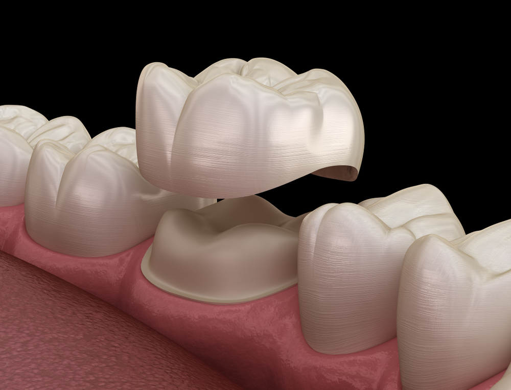 A 3D example of Dental Crowns