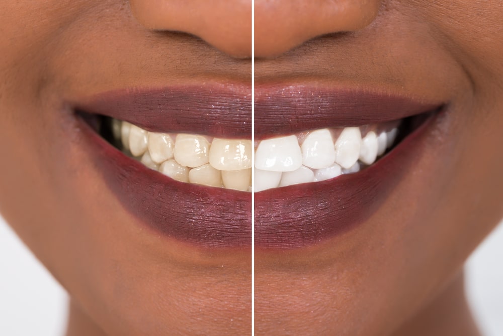 Smiling Woman Teeth Before And After Whitening