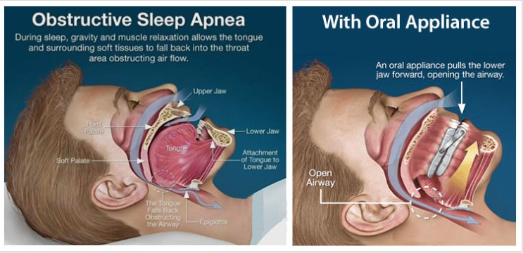 Person sleeping with an oral appliance to help with Sleep Apnea