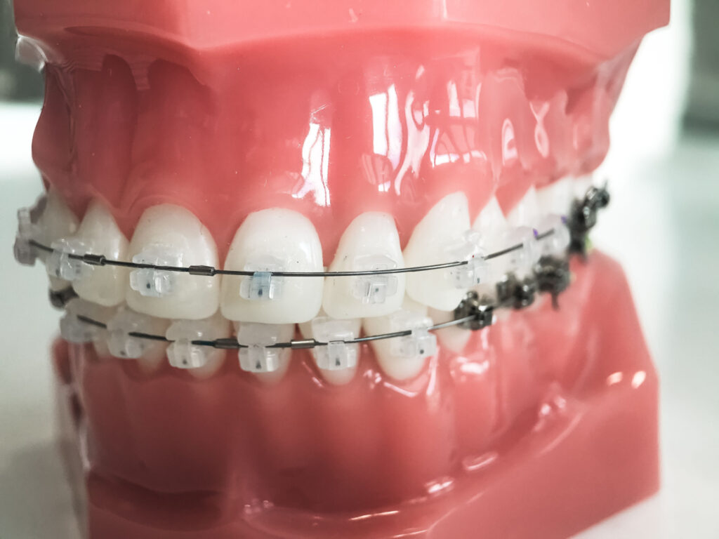 An example of self-litigating braces on a mold
