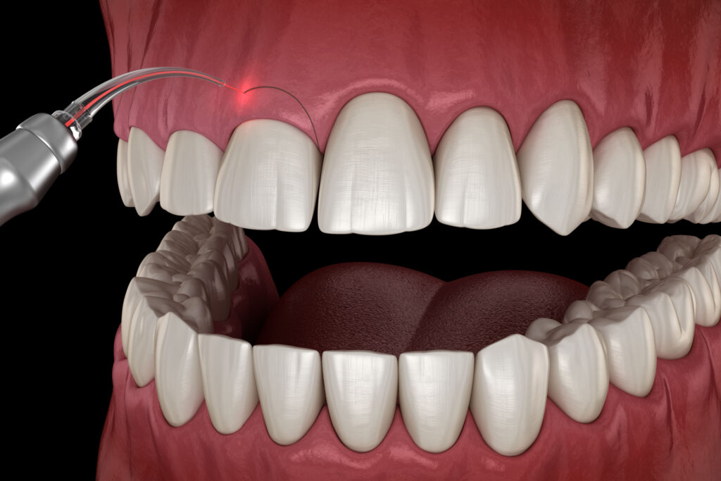 An example of the Gingivectomy process