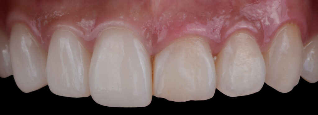 An example of Dental Crown Lengthening