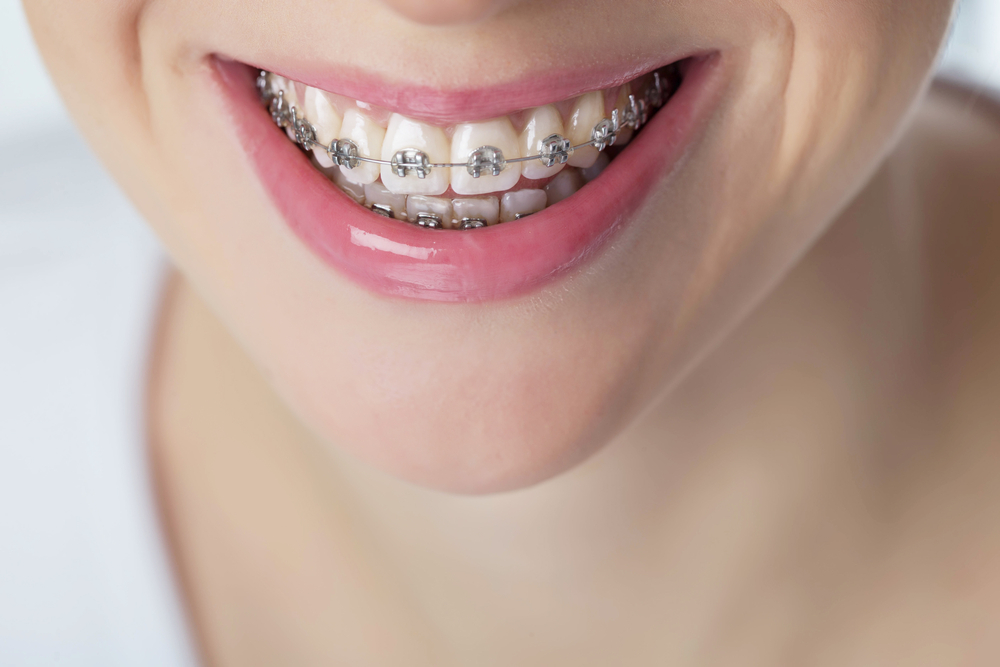 Person smiling with braces
