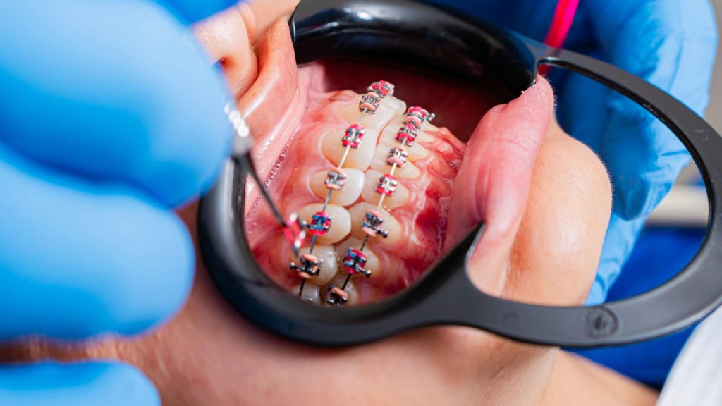 Braces in South Holland IL Metal & Self Ligating Options