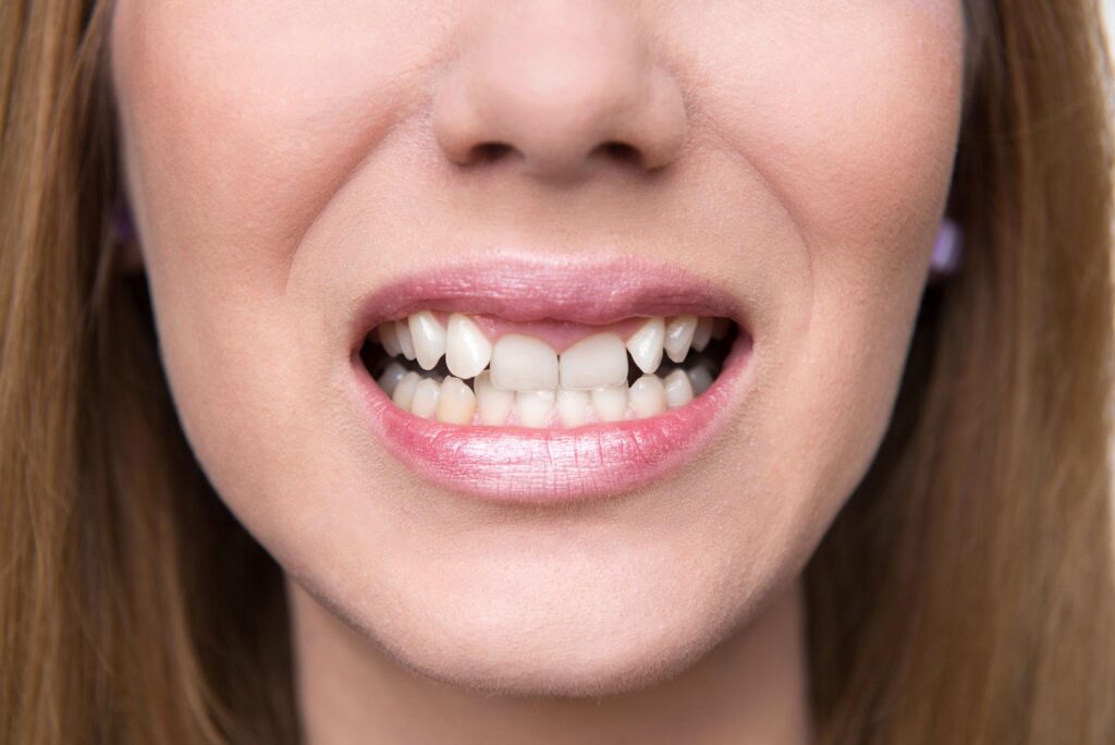 Crooked Teeth in Adults Why They Shift and Why It Matters